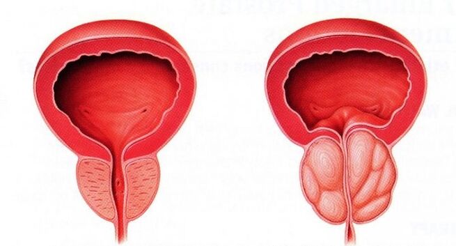 zdrowa i zapalona prostata z przewlekłym zapaleniem prostaty