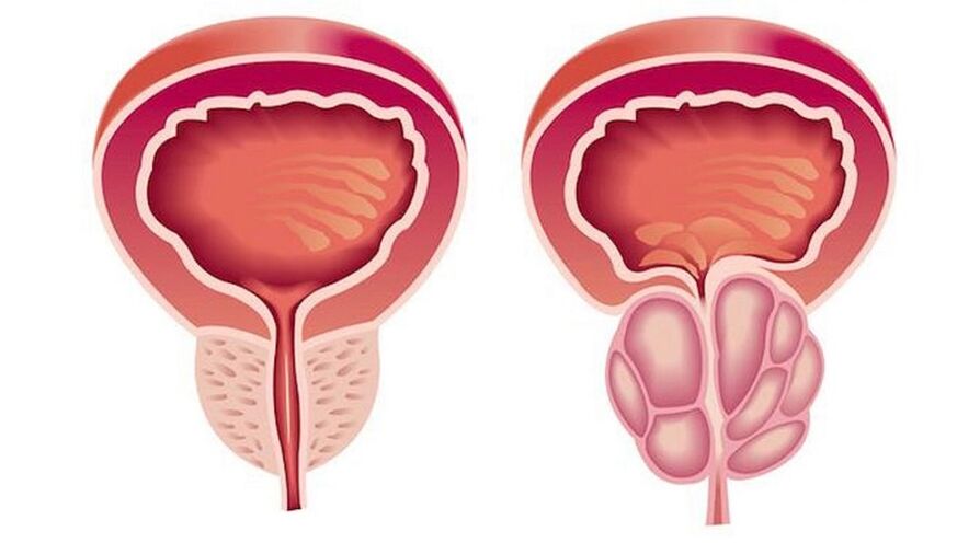Zdrowa i zapalna prostata z zapaleniem prostaty